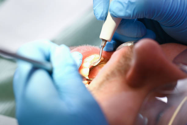 Best Emergency Wisdom Tooth Extraction in Deephaven, MN